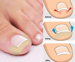 Ingrown Toenail Correction Patch (100pk)